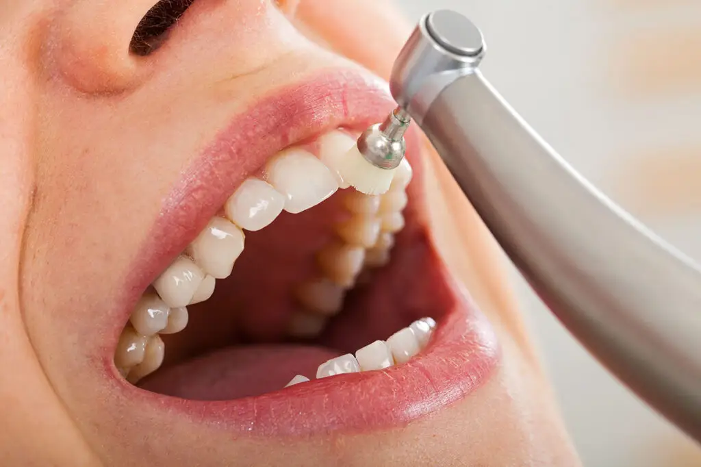 Professional Dental Cleanings in Lowell: What Brushing and Flossing Cannot Remove