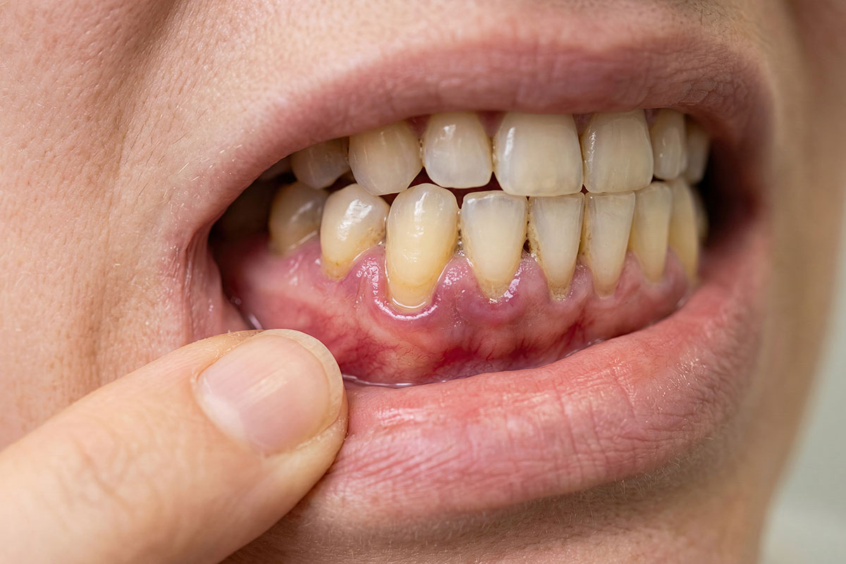 Bleeding Gums in Lowell: Common Causes and When to See a Dentist